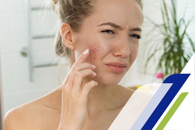 boicotear Arriba Matemático Cómo tratar el acné en la adolescencia paso a paso | Protex®